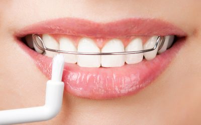 Why Seeing a Teeth Whitening Dentist is the Most Practical Solution